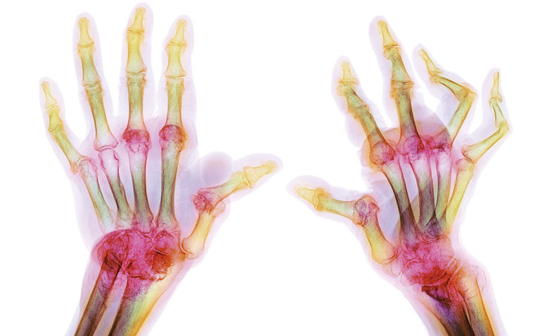 Rheumatoid arthritis in adults: updated NICE guidelines