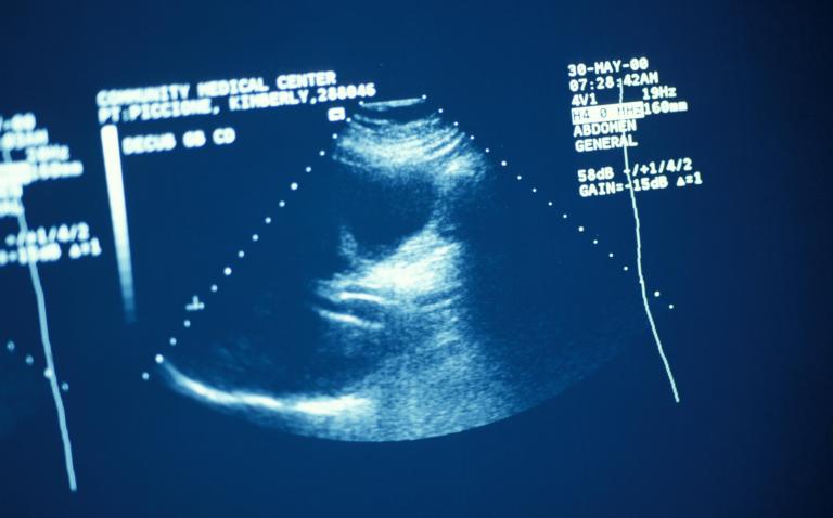 Concern over safety of commercial ultrasound scans