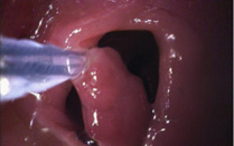 Invendoscopy safe and effective in colorectal cancer screening