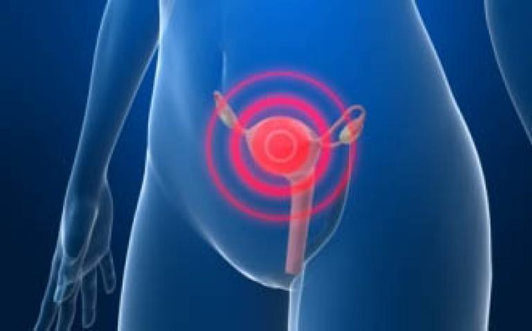Almac validates novel test for ovarian cancer patients