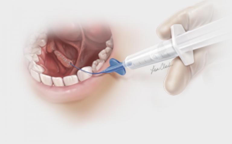 Cook Medical launches SialoCath™ salivary duct catheter
