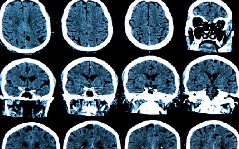 £25m funding stimulates dementia and neuroscience research at University of Cambridge
