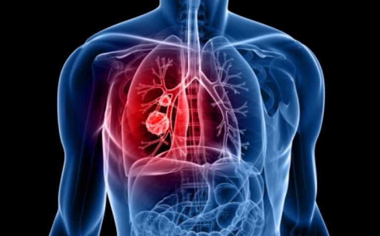 New online Smart Map shows progress in UK lung cancer care