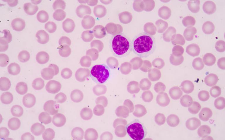 Venetoclax receives positive opinion for chronic lymphocytic leukaemia in the UK