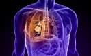 Tagrisso demonstrates superiority over chemotherapy in mutation-positive NSCLC
