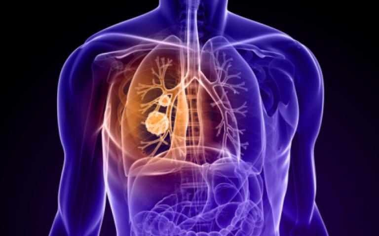 Tagrisso demonstrates superiority over chemotherapy in mutation-positive NSCLC