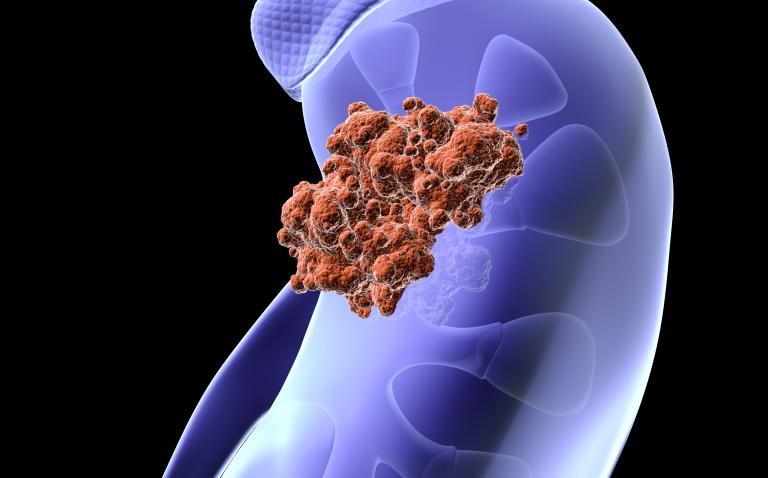 NICE recommends tivozanib as first-line treatment for advanced renal cell carcinoma