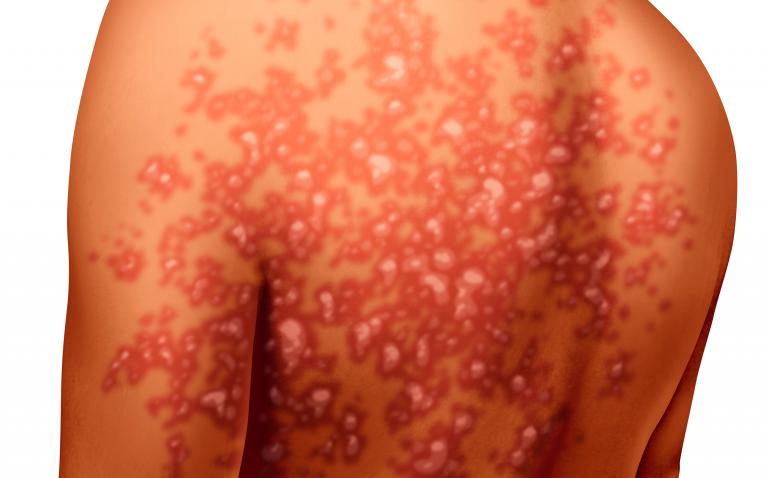 NICE Final Appraisal Determination for guselkumab to treat moderate to severe plaque psoriasis