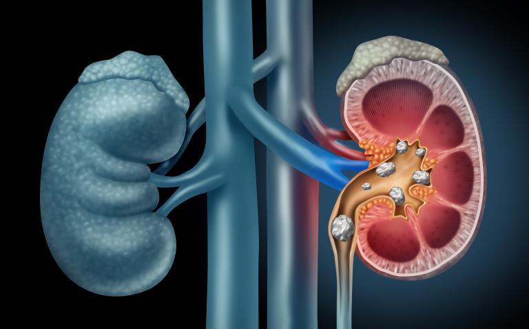 Oral antibiotics may raise risk of kidney stones