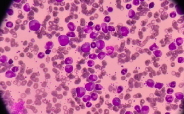 European Commission approves Vyxeos to treat certain types of  high-risk acute myeloid leukaemia
