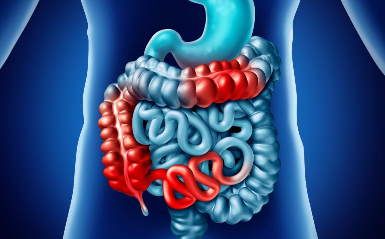 Ustekinumab shows sustained efficacy in improving remission rates in Crohn’s disease over three years