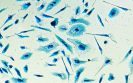 New treatment for prostate cancer receives European licence