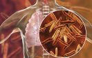 New rapid blood tests for TB could accelerate diagnosis