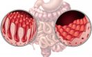 Immunological scarring from coeliac disease