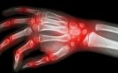 Deleting gene could help alleviate rheumatoid arthritis