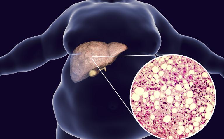 Expert view: Is NAFLD a ticking time bomb?