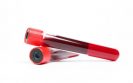 Prognostic test could enable personalised treatment of IBD