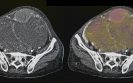 Lynparza approved for first-line maintenance treatment of BRCA-mutated advanced ovarian cancer