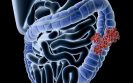 Targeted therapy combination improves survival in patients with advanced bowel cancer