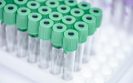Serum biomarkers in rheumatology and autoimmunity: do we need more?