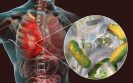 Ivacaftor may reduce common infections in patients with CF