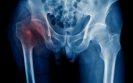 Excellence payments to hospitals improve hip fracture care