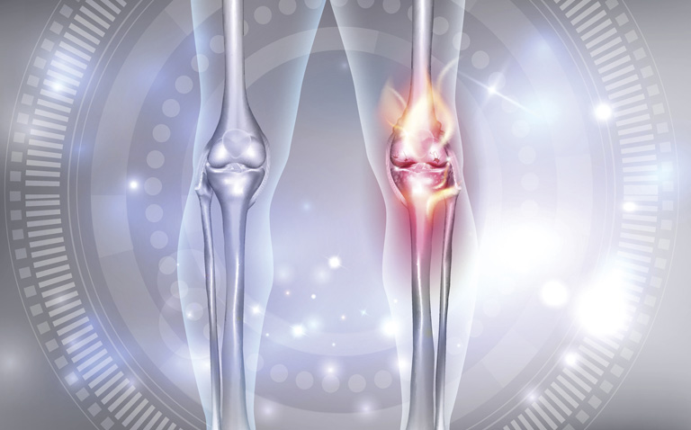 ‘Noisy knees’ to diagnose osteoarthritis