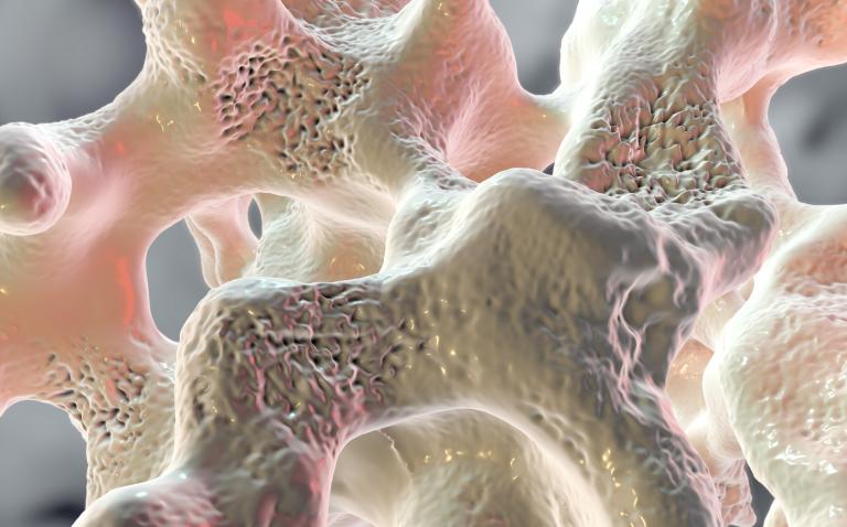 Experts consider osteoporosis to be a silent epidemic, which is neglected and under-addressed