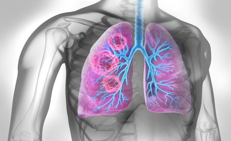 Shortness of breath and cough increase as first symptoms of lung cancer
