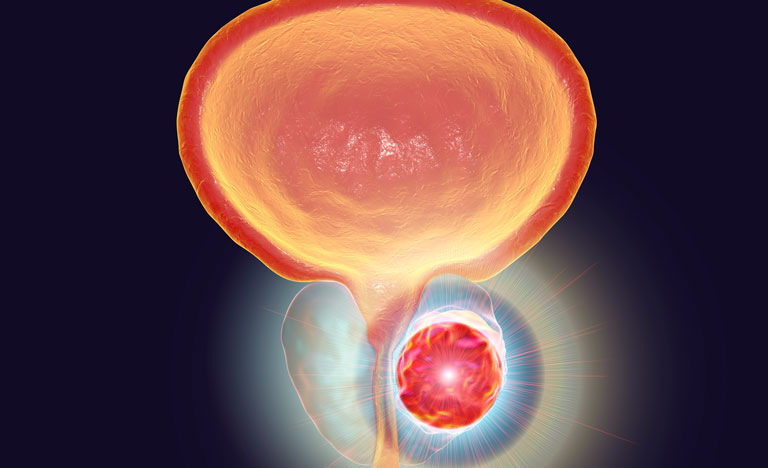 Researchers discover prostate cancer ‘fingerprint’