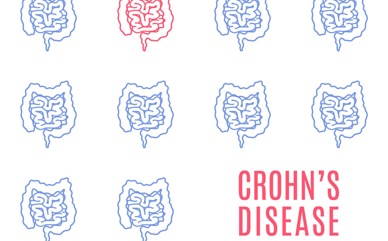 Preserving inflammation-free phases in Crohn’s disease