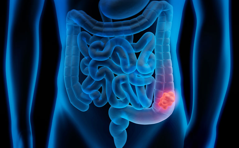 Delays in colorectal cancer screening predicted to significantly increase number of advanced cases