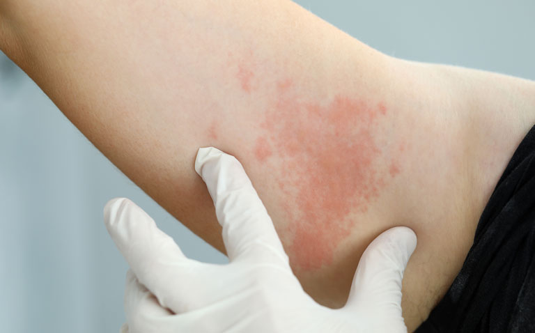 Uncertainty over the efficacy of up-dosing antihistamine in chronic urticaria