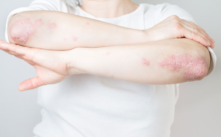 Real-world data show that biologics for psoriasis are less effective in practice