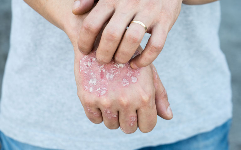 NMA and biologics in plaque psoriasis