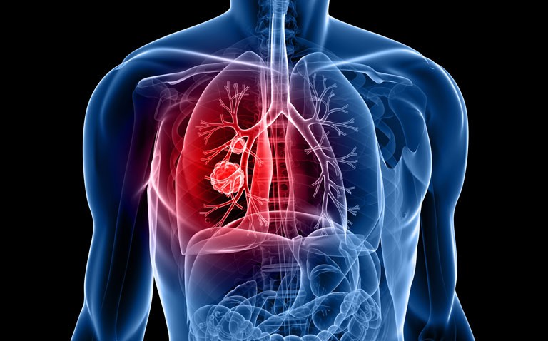 Laser infrared imaging and AI identifies lung adenocarcinoma