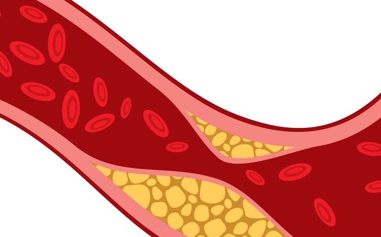 Elevated low-density lipoprotein in childhood highlights the need for early risk screening
