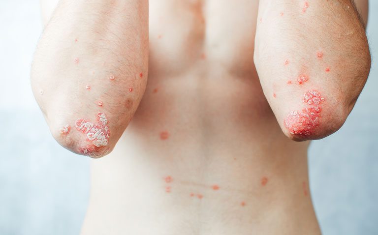 NICE approves Cosentyx for children and young people with psoriasis