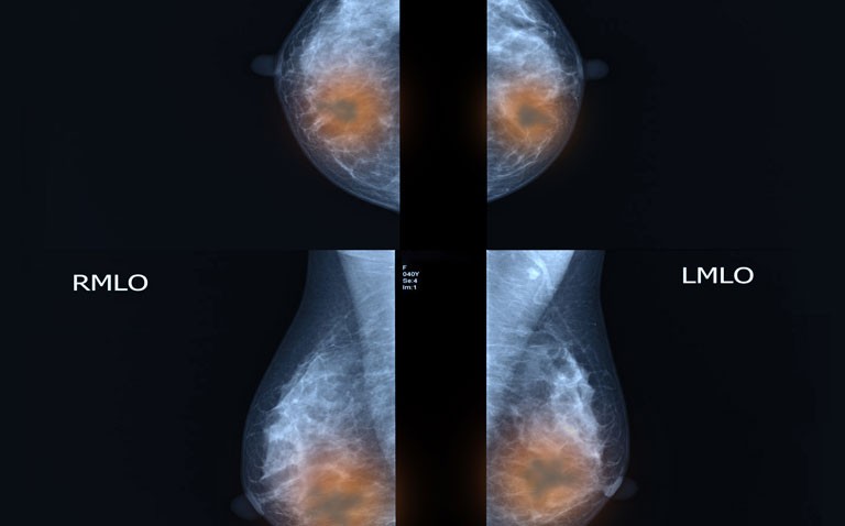 Deep learning breast MRI distinguishes between benign and malignant cases in women with dense breasts