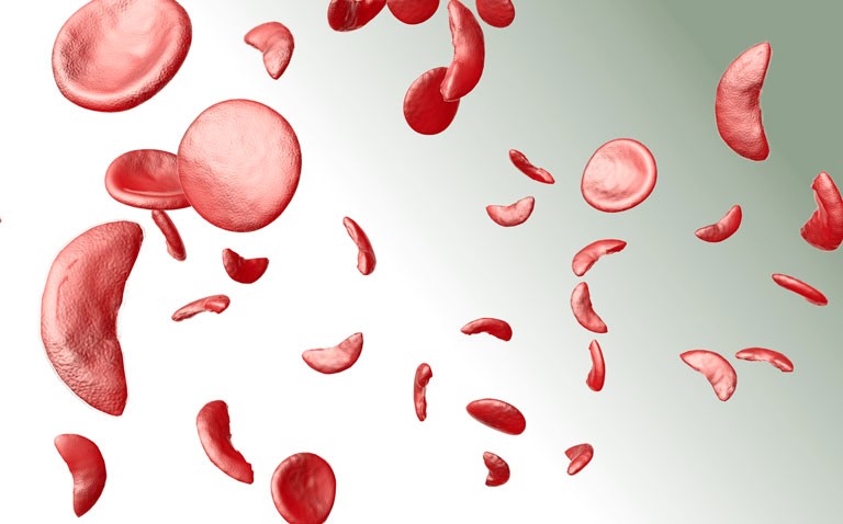sickle cell disease