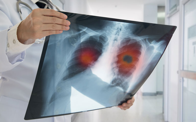 Tepotinib authorised for advanced non-small cell lung cancer with METex14 skipping