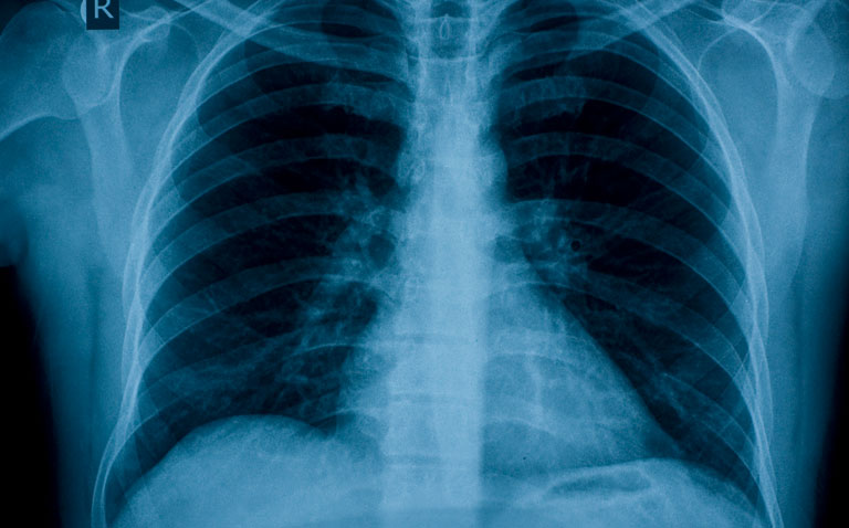 Abnormal chest x-ray increases probability of detecting intrathoracic malignancy