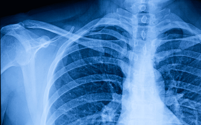 Dark field X-ray detects emphysema  in patients with COPD