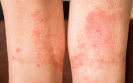 atopic eczema