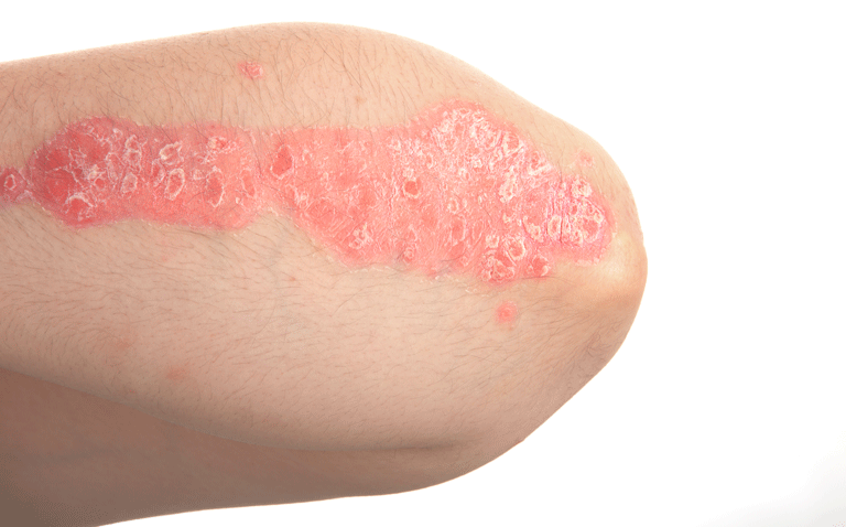 Tapinarof cream effective for moderately severe plaque psoriasis