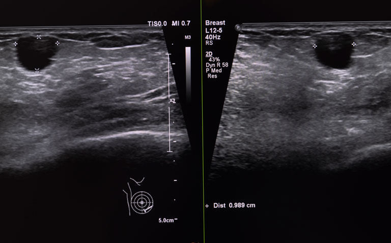 Diagnostic ultrasound shows highest accuracy for intra-operative margin assessment in breast cancer excision