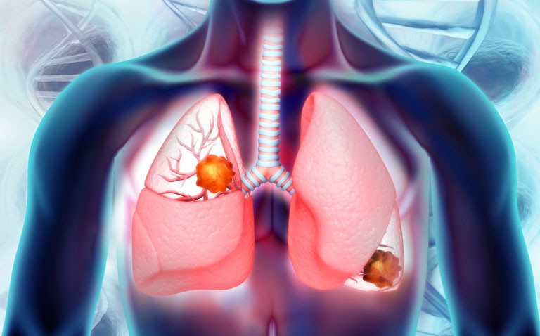 Atezolizumab approved by MHRA for non-small cell lung cancer