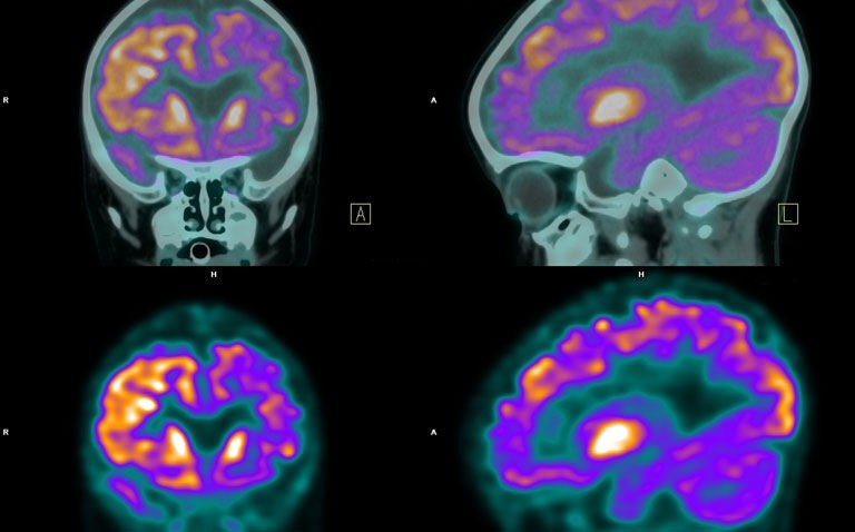 Higher tau levels in Alzheimer's seen on PET scans linked to psychosis and cognitive decline