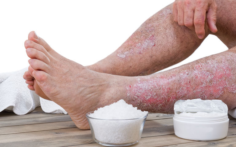Psoriasis patients self-report higher analgesic usage largely due to joint pain