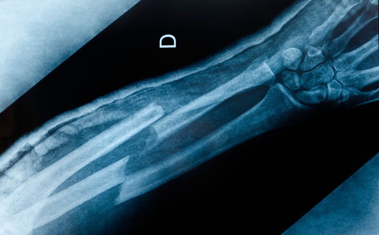 Fracture detection rates comparable between AI and clinicians